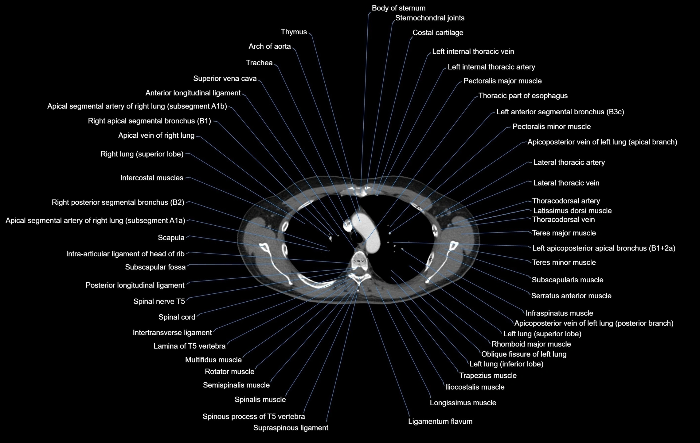 CT chest (thorax) soft tissue window labelled axial cross sectional anatomy radiology image-00038.webp
